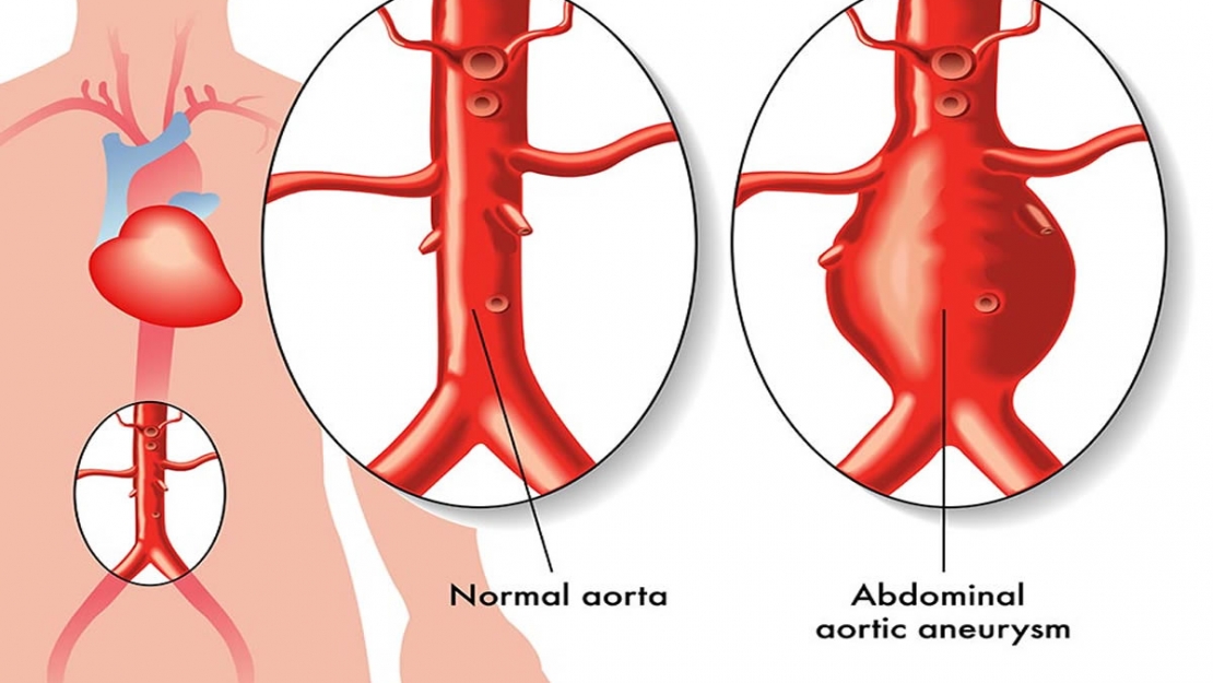 Ανευρύσματα Αορτής