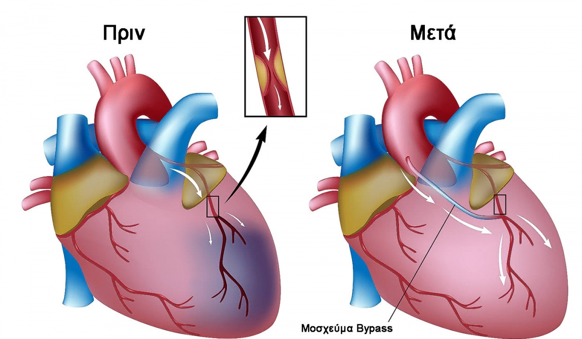 Aoρτοστεφανιαία Παράκαμψη ή by-pass