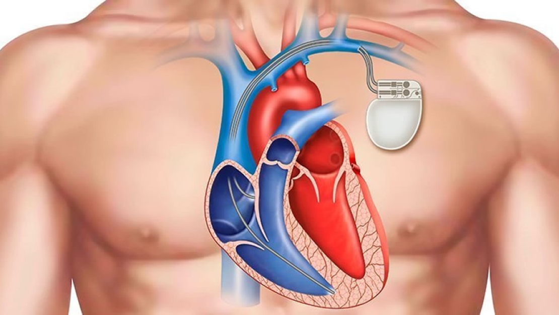 Εμφυτεύσιμοι Βηματοδότες καρδιάς 