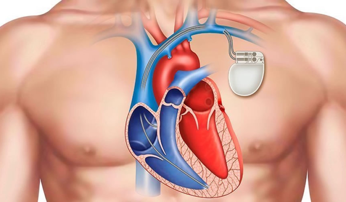 Εμφυτεύσιμοι Βηματοδότες καρδιάς 
